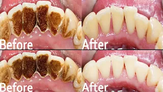 Tartar vs. Plaque How To Remove Plaque From Teeth - Remove Dental Plaque In 5 Minutes without goin