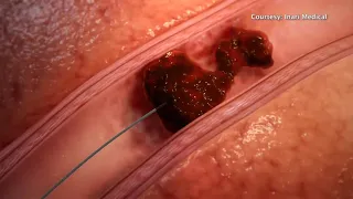 FLOWTRIEVER REMOVES BLOOD CLOTS IN A FLASH!