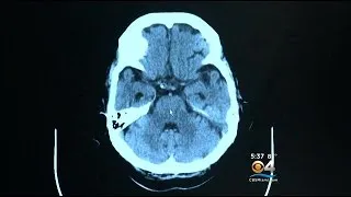 New Drug Being Tested That Could Be Treatment For Alzheimers