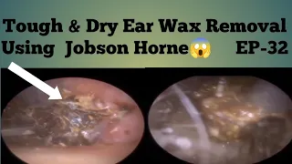 TOUGH & DRY EAR WAX REMOVAL USING JOBSON HORNE- EP32