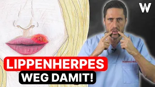 Lippenherpes: Wieso kommt Herpes immer wieder? Behandlung & Vorbeugung von Herpesbläschen | Ursachen