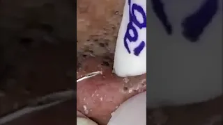 Huge Satisfying Blackheads Removed Part 82