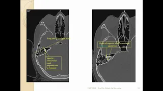 HOW TO READ CT SCAN TEMPORAL BONE - A SIMPLIFIED VIEW