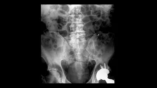 Bone Scintigraphy I : Basics