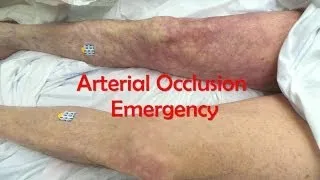 Acute, Complete Occlusion of the Leg Arteries