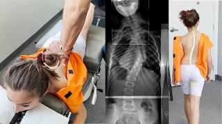 Scoliosis Treatment with Gonstead Chiropractic Care |Ep2| Dr. Rahim