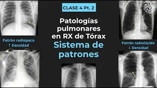 04.2 - Tórax anormal: Patrones radiológicos (consolidación, atelectasia, bula, cavitación, etc)