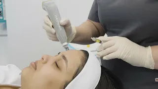 Micro-Needling Explained with Sam