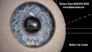 Z LASIK How Bladeless Eye Surgery Works