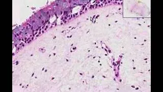 Histopathology Nose --Nasal polyp