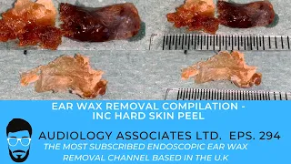 EAR WAX REMOVAL COMPILATION - INC HARD SKIN PEEL - EP 294