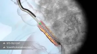 3D Medical Animation of Tracheal Stent Procedure