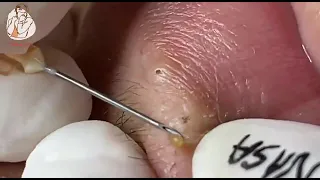Relexing blackhead popping with Nasa Spa