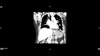 CT Aortogram - traumatic aortic dissection (2)