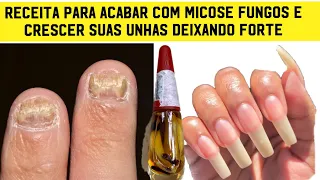 DEPOIS QUE MINHA MÃE ENSINOU ESTA DICA PARA UNHAS CRESCER E MATAR MICOSE FUNGO NUNCA MAIS FICO SEM