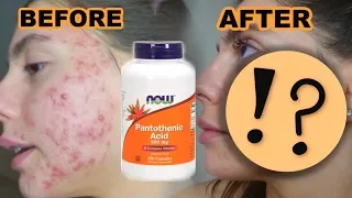 3 MONTHS OF TAKING PANTOTHENIC ACID FOR MY ACNE.. IS IT WORTH IT.