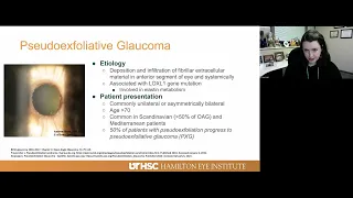 Lecture: Pigmentary and Pseudoexfoliative Glaucoma