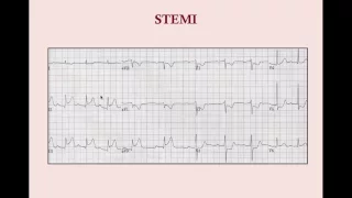 Acute Coronary Syndromes (old version, with sound) - CRASH! Medical Review Series