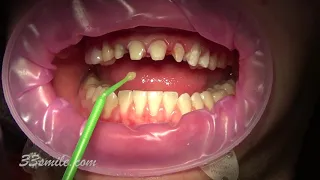 porcelain dental crowns and porcelain dental veneers before and after