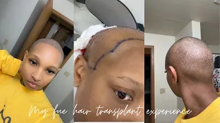 MY FUE HAIR TRANSPLANT EXPERIENCE| TURKEY LONGEVITA