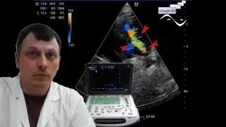 Pediatric Cardiac ultrasound - Patent ductus arteriosus