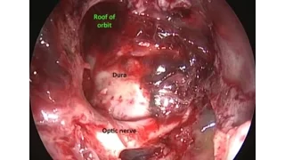 Ossifying fibroma - Dr.Satish Jain - www.skullbase360.in