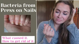 AVOID Nail Bacteria from Press on Nails | What I did | How to get rid of it