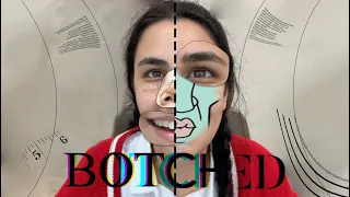 My BOTCHED Nose Job Reveal...