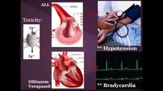 Calcium Channel Blocker (CCB) Toxicity:  "EM in 5"