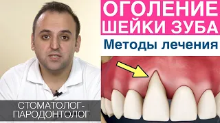 Рецессия десны - методы лечения оголения шейки зуба