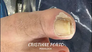 🤤| GENTE, QUE PROCEDIMENTO SATISFATÓRIO! #ingrown_toenail #satisfying #nails #peeling