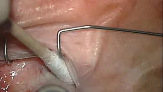 Anterior chamber paracentesis, aqueous release after intra vitreal Triesence injection mp4