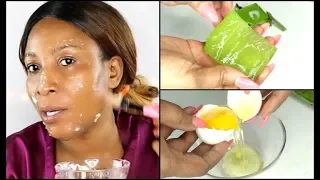 NO JOKE USE EGG AND ALOE VERA, WATCH YOUR FACE TRANSFORM, Live Demo |Khichi Beauty