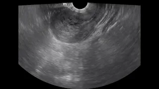 molar pregnancy