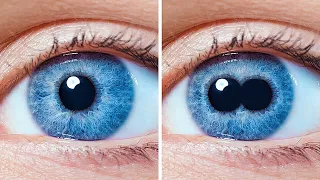 Zwei Pupillen in einem Auge Und andere seltsame Körperkuriositäten