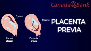Placenta Previa