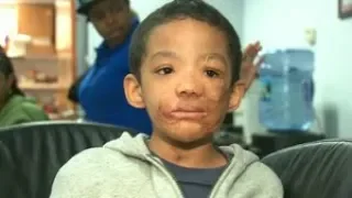 Young boy attacked by pit bull surprised with trip to Disney World