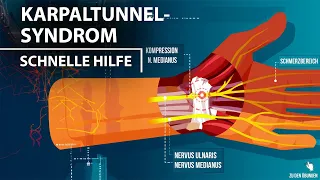 Karpaltunnelsyndrom  | Soforthilfe 3 Übungen | ohne Equipment