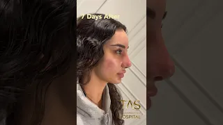 Scarless Facelift and Revision Rhinoplasty by Dr.TAS