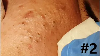 BIG BLACKHEADS EXTRACTIONS on Happy :)  #2