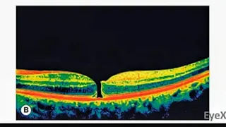 Macular Hole - Basics & Management