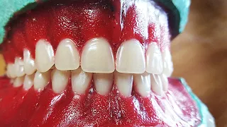 Denture Special carving or denture festooning for denture for natural esthetics in hindi