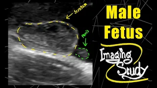 Male Fetus - Its a Boy  || Ultrasound || Case 123
