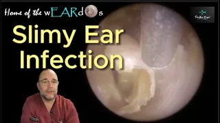 SLIMY EAR INFECTION 225 #ear #earwax #earwaxremoval #earcleaning #asmr #asmrearwax #infection #peel