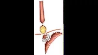 Animation Normal - Gastric Banding System