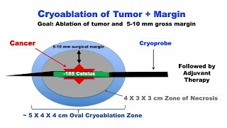 Breast Cryoablation Guideline  Part 1 of 2