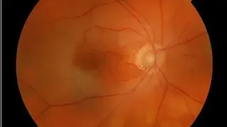 Retinal artery occlusion