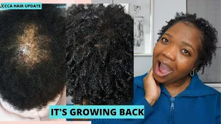 CCCA HAIR LOSS JOURNEY UPDATE || CCCA ALOPECIA