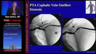 Management and Access Stenosis and Occlusion (Mark Mattos, MD)