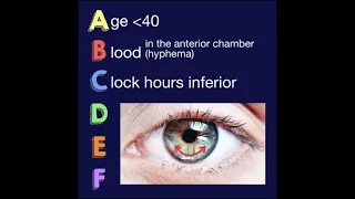 The ABCDEF Guide for Iris Nevus Growth to Melanoma by Carol Shields